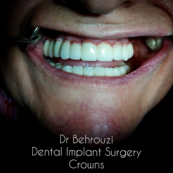 Dental prosthesis(پروتزهای دندانی)